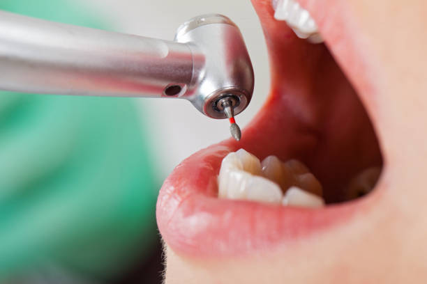 Best Emergency Root Canal Treatment in Fort Totten, ND